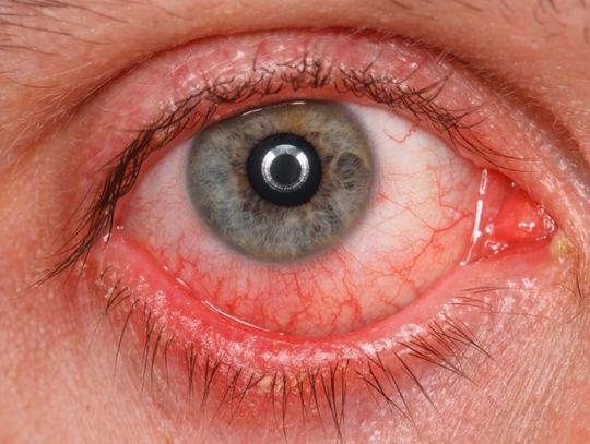 Do sądu za poparzone oczy | Super Tydzień