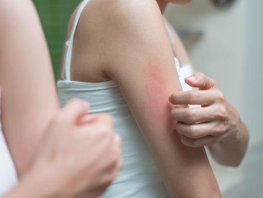 Jak rozpoznać alergię skórną?