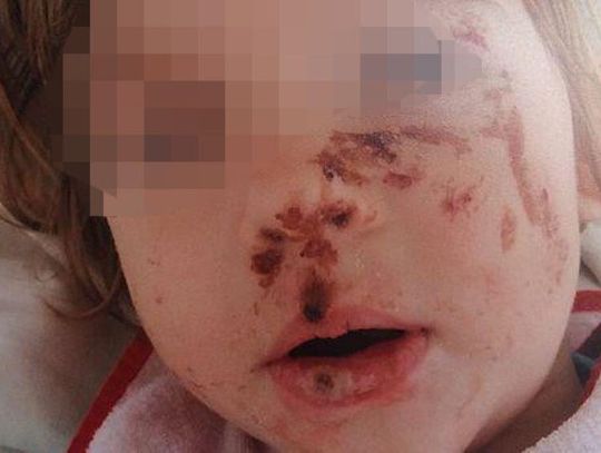 Oblewała córkę żrącą substancją. Dramat 10-letniej dziewczynki