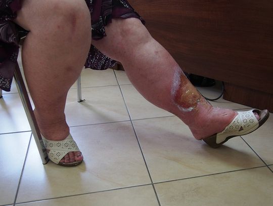 Poszła po winogrona, wróciła z raną na nodze