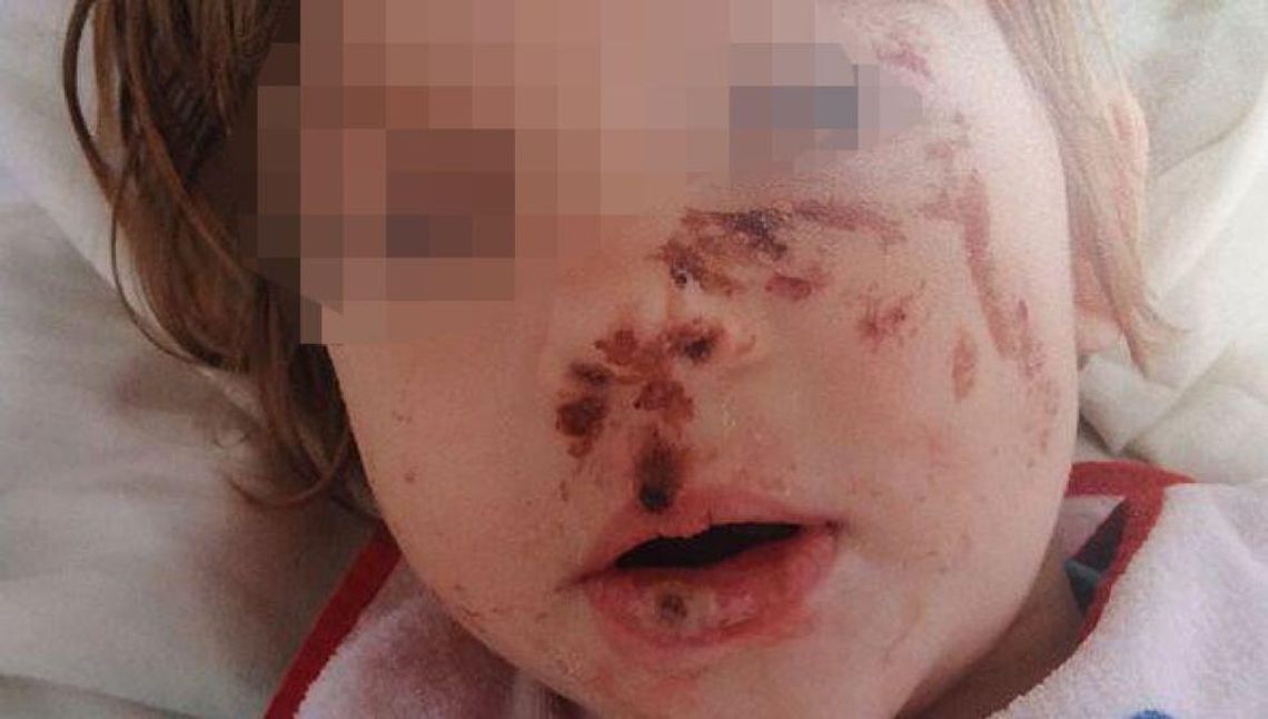 Oblewała córkę żrącą substancją. Dramat 10-letniej dziewczynki